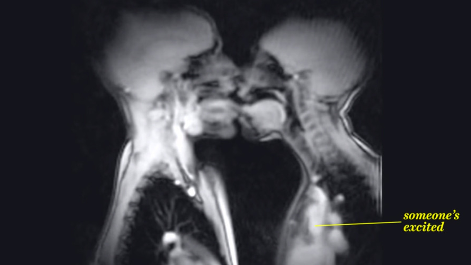 Suudelma MRI-kuvassa