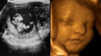 Vauva ultraäänikuvassa ennen ja nyt